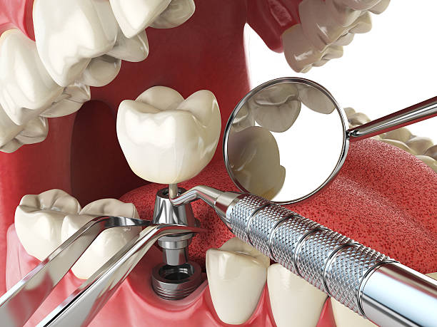 Best Emergency Dental Extractions in Anna, OH